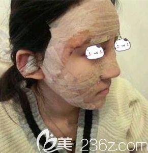 谢靓花主任帮我做自体脂肪面部填充术后即刻 谢靓花主任帮我做自体脂肪面部填充术后即刻