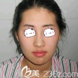 到赣州韩美整形美容医院面诊前面部凹陷的自己 到赣州韩美整形美容医院面诊前面部凹陷的自己