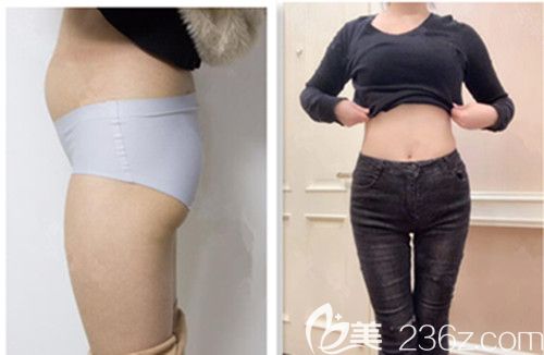 株洲华美年华腰腹吸脂亲身经历真实反馈：一个月后貌似有“腰”了，附前后效果对比图