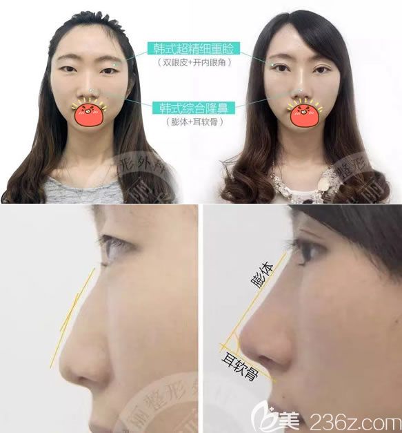 瑞安瑞丽王俞明鼻综合隆鼻案例 瑞安瑞丽王俞明鼻综合隆鼻案例