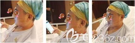 上海艺星医疗美容医院彭才学半肋骨+膨体隆鼻真人案例术后第二天