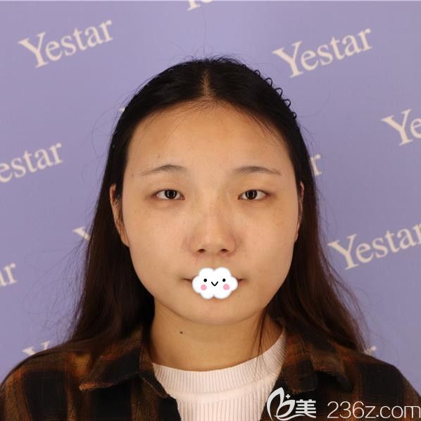 武汉艺星<!--<i data=20240703-sp></i>-->双眼皮+隆鼻+下巴整形案例 武汉艺星<!--<i data=20240703-sp></i>-->双眼皮+隆鼻+下巴整形案例