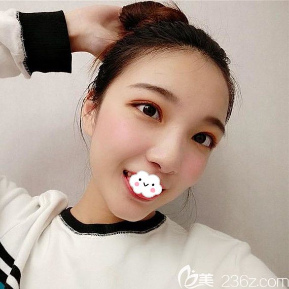 武汉艺星美杜莎双眼皮真人案例 武汉艺星美杜莎双眼皮真人案例