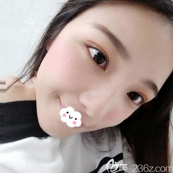 武汉双眼皮医生哪个好?武汉艺星<!--<i data=20240703-sp></i>-->案例 武汉双眼皮医生哪个好?武汉艺星<!--<i data=20240703-sp></i>-->案例