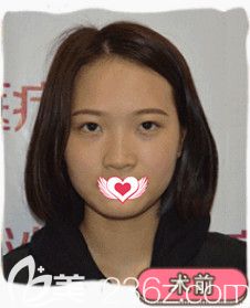 在邢台美加美做鼻综合术前是塌平的鼻子 在邢台美加美做鼻综合术前是塌平的鼻子