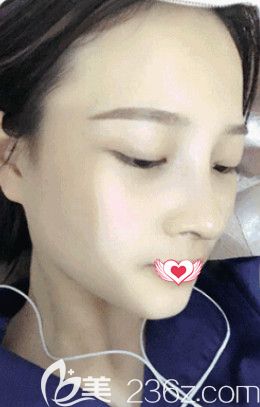 邢台遇见美韩伟强院长做达拉斯鼻综合手术为我雕刻宛若天生的优雅鼻