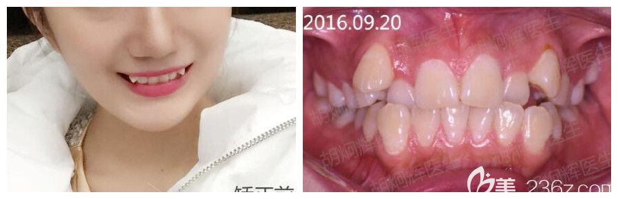 去从重庆牙博士口腔做虎牙矫正前照片 去从重庆牙博士口腔做虎牙矫正前照片