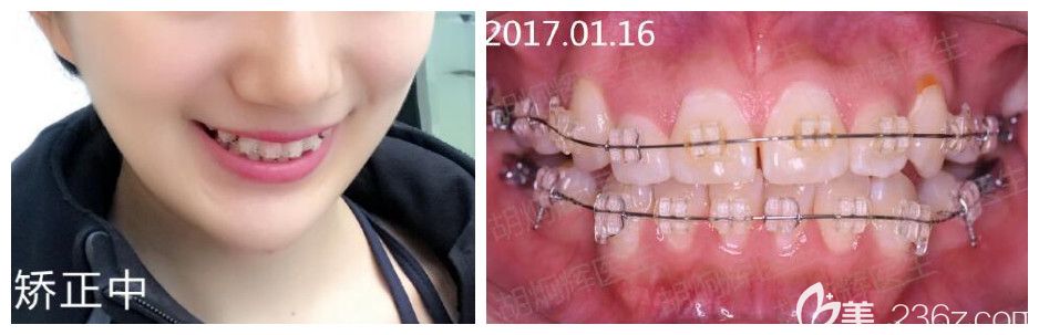 找胡炯辉做虎牙矫正快4个月效果 找胡炯辉做虎牙矫正快4个月效果