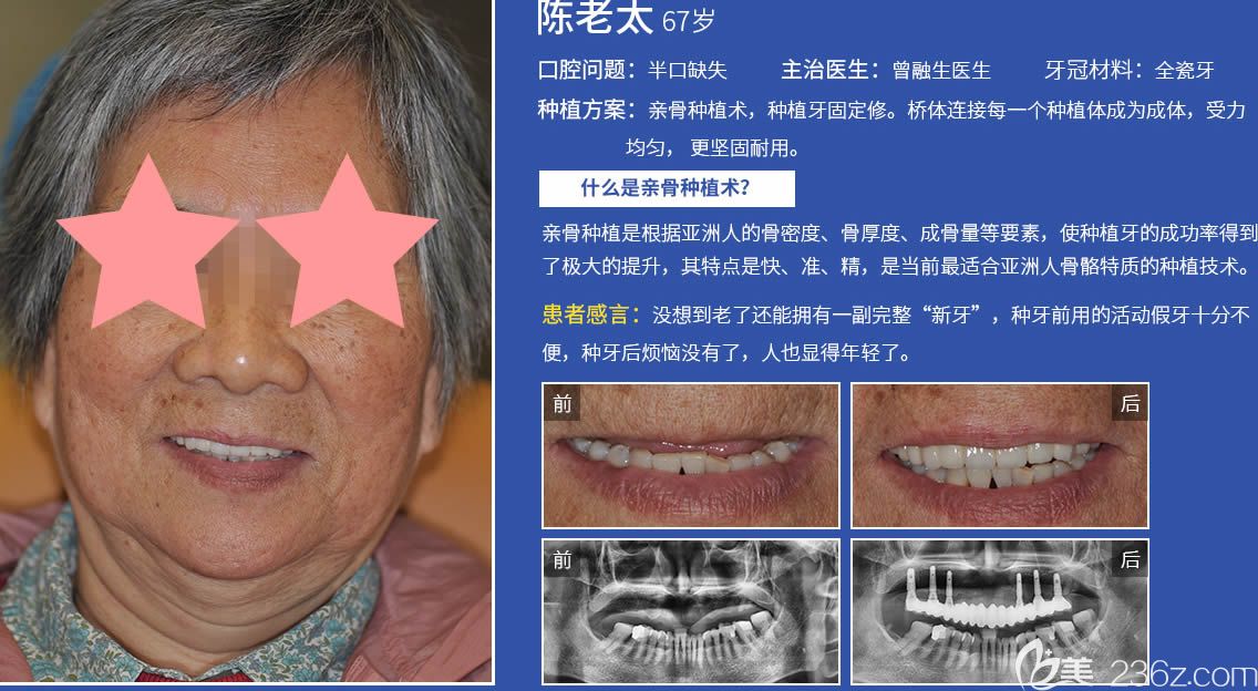 广州圣贝口腔种植牙真人案例效果图