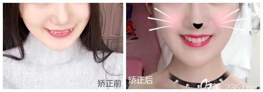 重庆牙博士口腔虎牙矫正前后对比照公布 重庆牙博士口腔虎牙矫正前后对比照公布