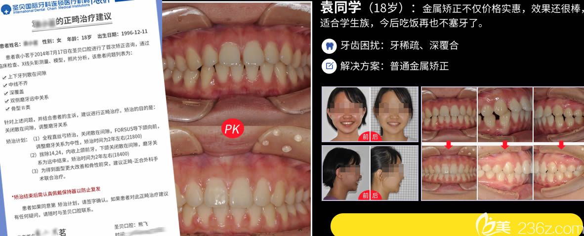 广州圣贝口腔熊飞牙齿正畸案例图