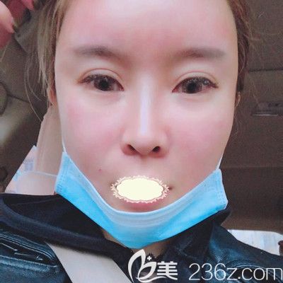 哈尔滨臻美<!--<i data=20240703-sp></i>-->面部自体脂肪填充术后1天效果展示