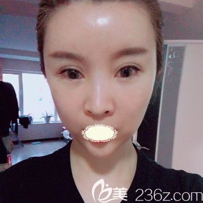 哈尔滨臻美<!--<i data=20240703-sp></i>-->面部自体脂肪填充术后7天对比图