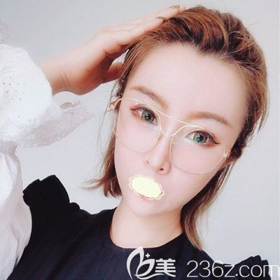 哈尔滨臻美<!--<i data=20240703-sp></i>-->面部自体脂肪填充术后18天效果图