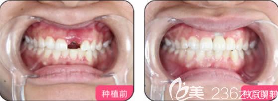 美奥口腔单颗牙缺失前后对比效果