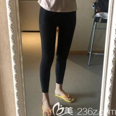 哈尔滨臻美<!--<i data=20240703-sp></i>-->腿部吸脂塑形术后20天效果照 哈尔滨臻美<!--<i data=20240703-sp></i>-->腿部吸脂塑形术后20天效果照