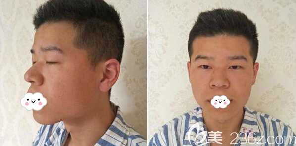 单眼皮和面部的凹陷一直是我的困扰 单眼皮和面部的凹陷一直是我的困扰