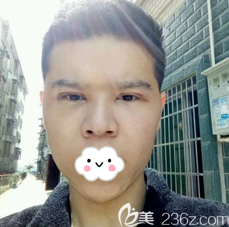 <i data-id='6f25ea73-45be-43f6-8020-50cbfcde0b3a' style='display:none;'></i>文科埋线双眼皮术后4天 <i data-id='6f25ea73-45be-43f6-8020-50cbfcde0b3a' style='display:none;'></i>文科埋线双眼皮术后4天