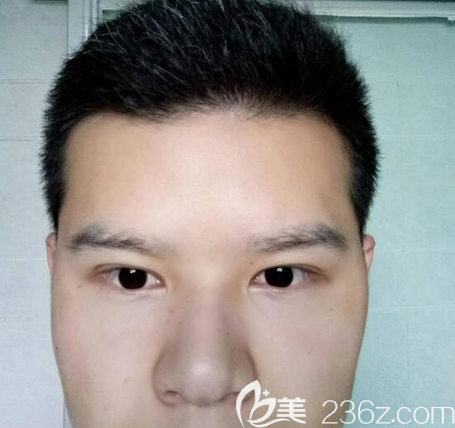 <i data-id='6f25ea73-45be-43f6-8020-50cbfcde0b3a' style='display:none;'></i>埋线双眼皮术后一个月 <i data-id='6f25ea73-45be-43f6-8020-50cbfcde0b3a' style='display:none;'></i>埋线双眼皮术后一个月