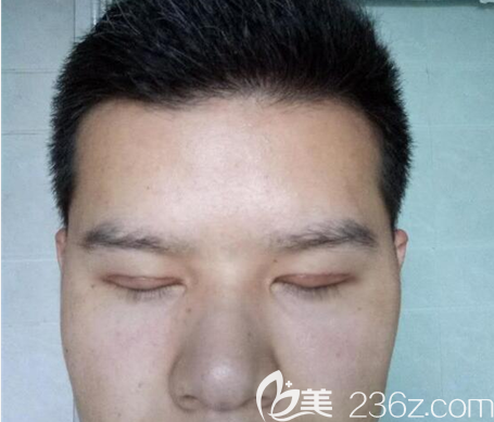 埋线双眼皮术后一个月闭眼效果 埋线双眼皮术后一个月闭眼效果