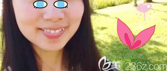 在天津美奥口腔医院戴牙套前 在天津美奥口腔医院戴牙套前