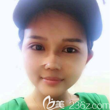 广州美恩许扬滨双眼皮隆鼻7天效果图 广州美恩许扬滨双眼皮隆鼻7天效果图