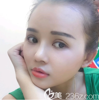 广州美恩许扬滨做双眼皮隆鼻子怎么样 广州美恩许扬滨做双眼皮隆鼻子怎么样