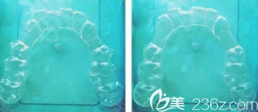 已经佩戴过的正雅牙套 已经佩戴过的正雅牙套