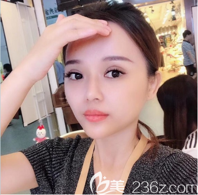 广州美恩双眼皮隆鼻术后恢复照片 广州美恩双眼皮隆鼻术后恢复照片