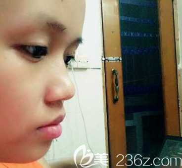 在广州美恩做双眼皮隆鼻术前照片 在广州美恩做双眼皮隆鼻术前照片