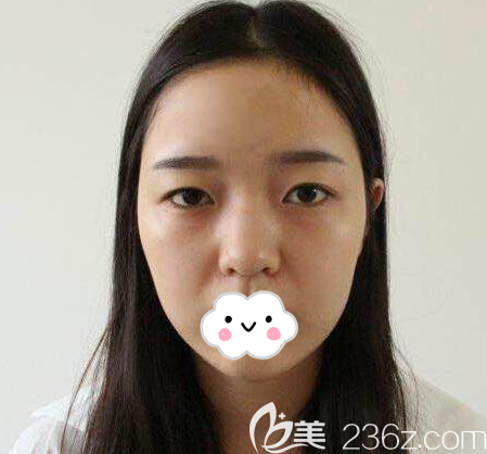 成都军大整形外科医院杨勇术前照片1