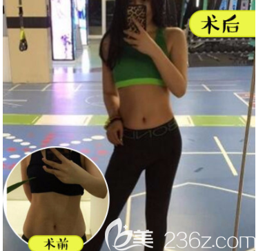 北京壹加壹王珂医生腰腹吸脂案例 北京壹加壹王珂医生腰腹吸脂案例