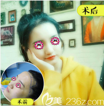 北京壹加壹郝文义医生发际线种植案例 北京壹加壹郝文义医生发际线种植案例