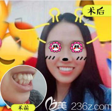 北京壹加壹张莹医生隐形托槽矫正案例 北京壹加壹张莹医生隐形托槽矫正案例