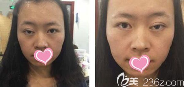 在<!--<i data=20240703-sp></i>-->美莱整形割双眼皮手术前 在<!--<i data=20240703-sp></i>-->美莱整形割双眼皮手术前