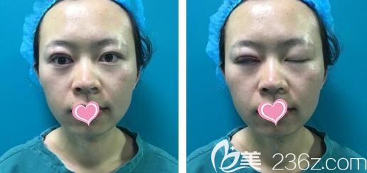 切开双眼皮手术第2天感觉眼睛酸酸的 切开双眼皮手术第2天感觉眼睛酸酸的