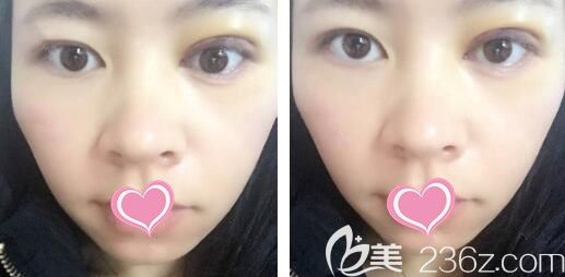 双眼皮失败修复第7天眼部线条流畅 双眼皮失败修复第7天眼部线条流畅