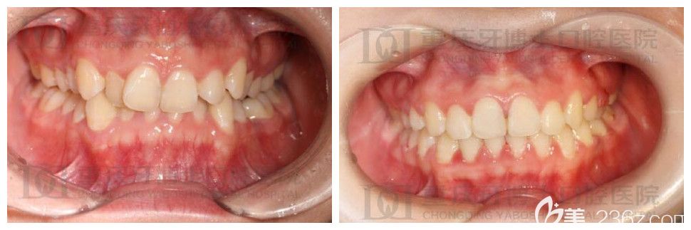 重庆牙博士口腔牙齿矫正怎么样?刘永桂正畸案例效果公布 重庆牙博士口腔牙齿矫正怎么样?刘永桂正畸案例效果公布
