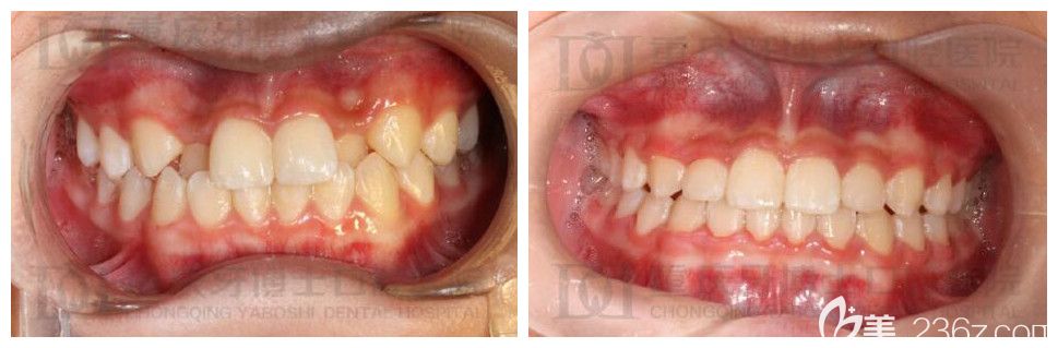 重庆牙齿矫正哪家强?牙博士刘永桂正畸案例实力验证 重庆牙齿矫正哪家强?牙博士刘永桂正畸案例实力验证