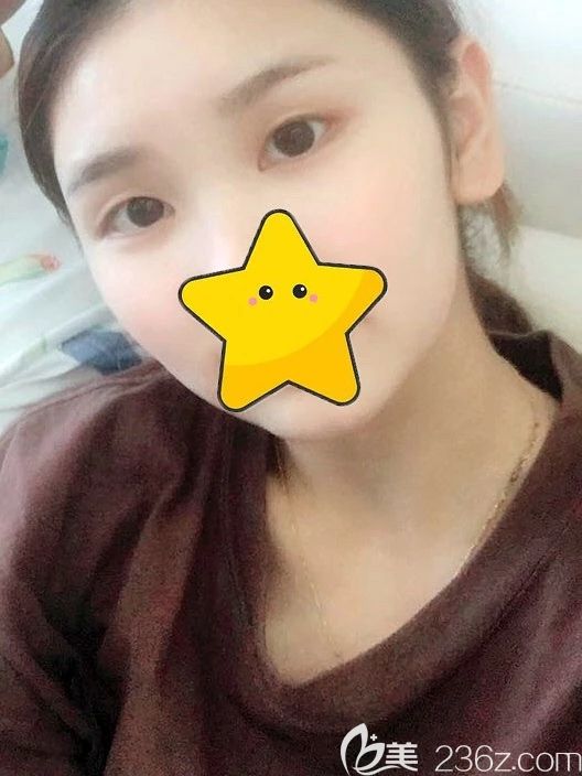 西宁时光全切双眼皮手术前 西宁时光全切双眼皮手术前