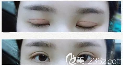 西宁时光全切双眼皮第3天 西宁时光全切双眼皮第3天