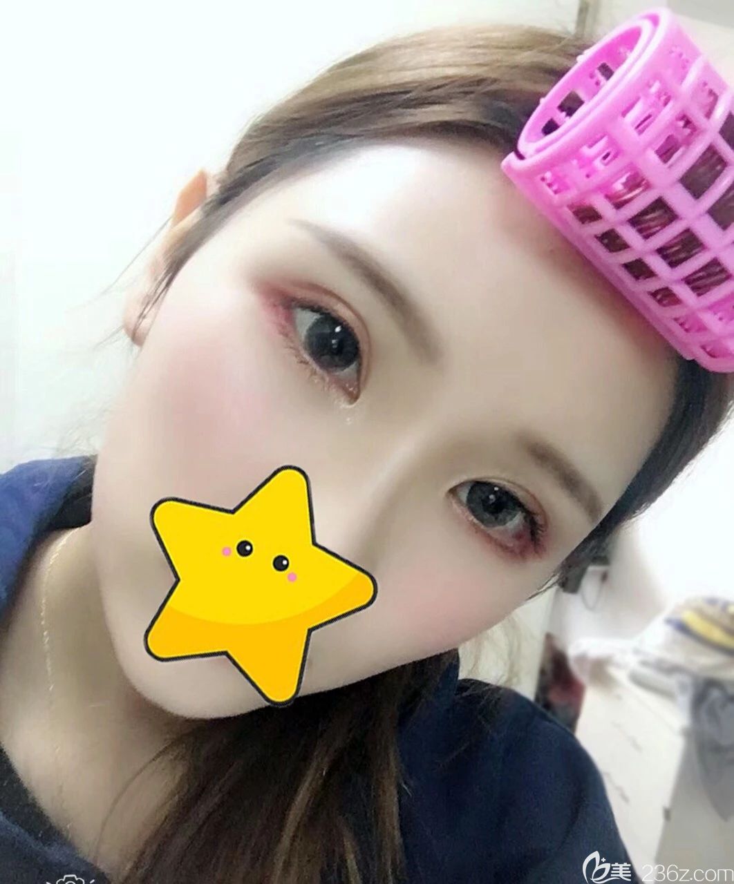 西宁时光<!--<i data=20240703-sp></i>-->全切双眼皮一个月恢复<span style= 西宁时光<!--<i data=20240703-sp></i>-->全切双眼皮一个月恢复<span style=