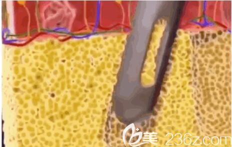 大腿环吸原理 大腿环吸原理