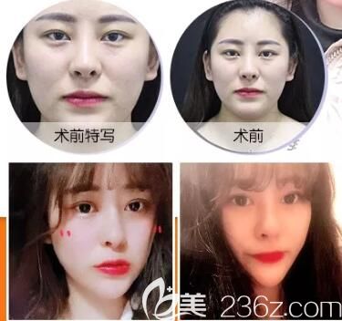 牛先翠主任自体脂肪面部填充术后效果对比