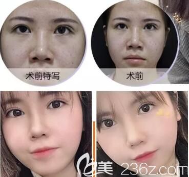 晏传涛主任眼综合整形术后恢复效果