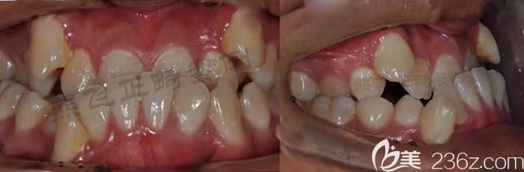 我做牙齿正畸之前的牙齿照片