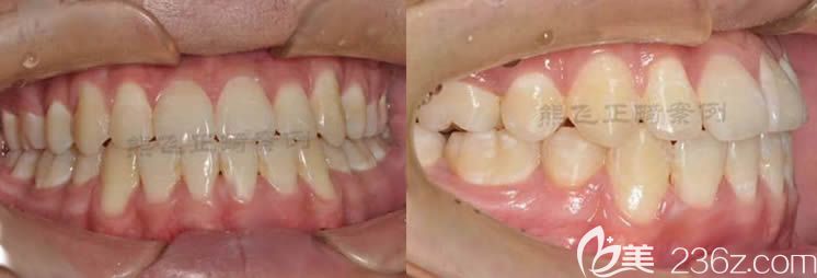 在广州圣贝口腔做牙齿矫正，历时两年半解除我牙齿反颌的地包天症状