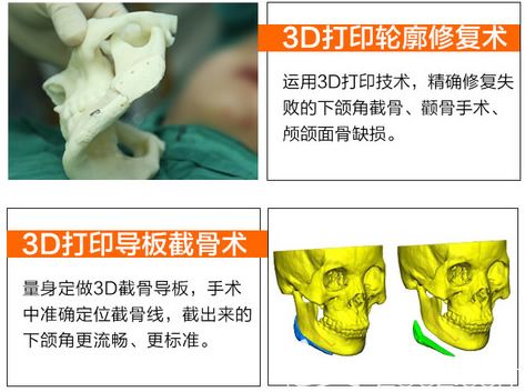 杭州连天美2019全新轮廓手术技术