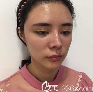 广州天姿脂肪填充术前照片 广州天姿脂肪填充术前照片