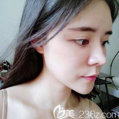 我去广州天姿整形医院找周祺院长做了全脸自体脂肪填充,因为面部凹陷让我看起来很显老